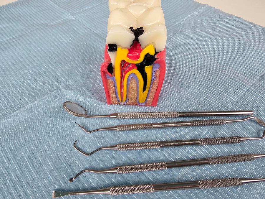 Root Canals
