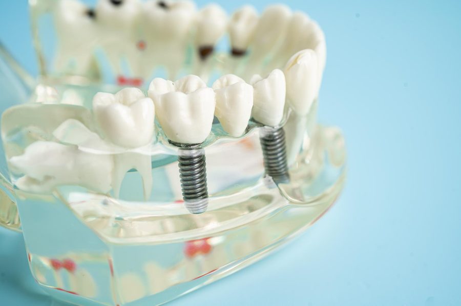 Implant Restoration