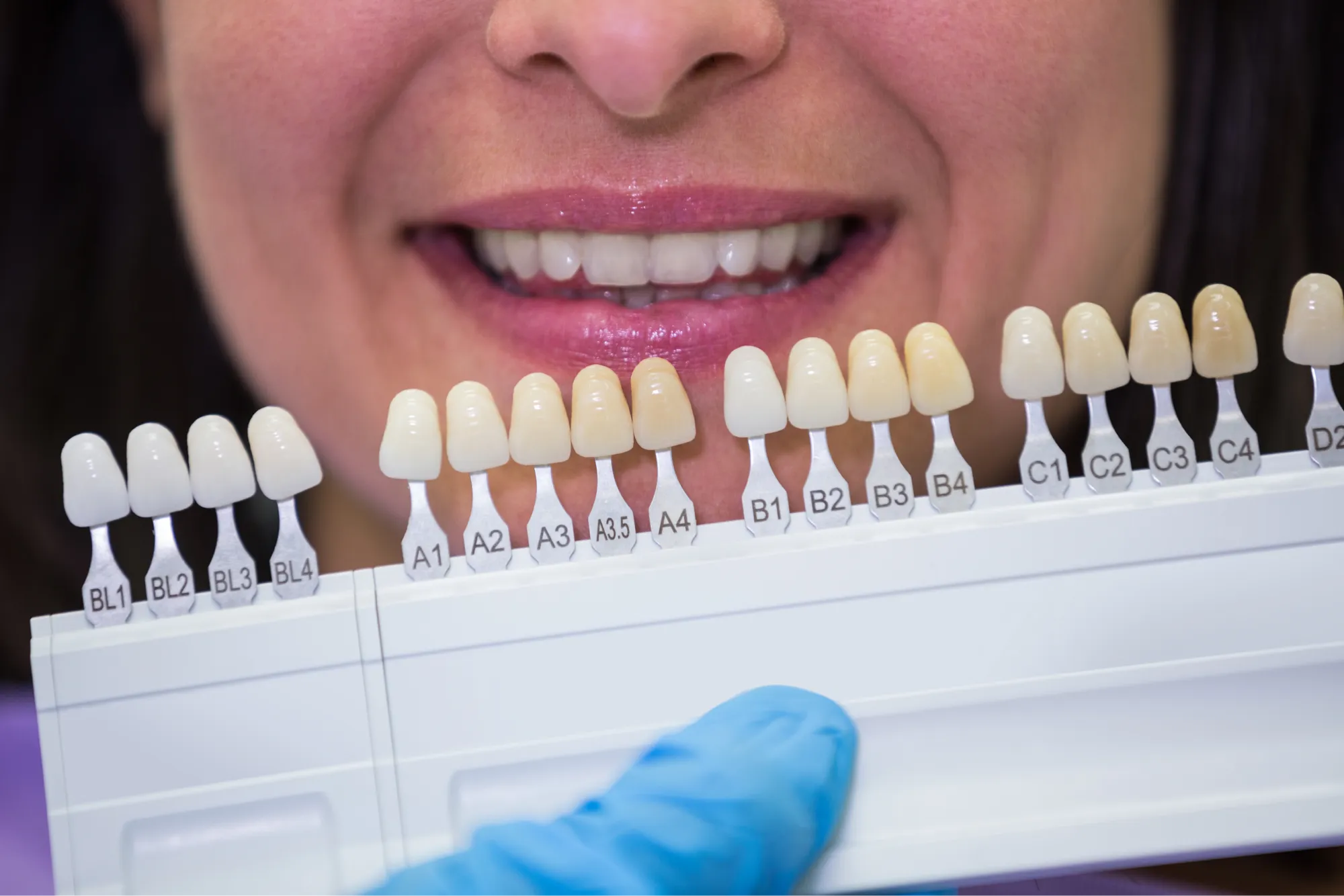 Professional Teeth Whitening in Jacksonville, FL | Achieve a Radiant Smile