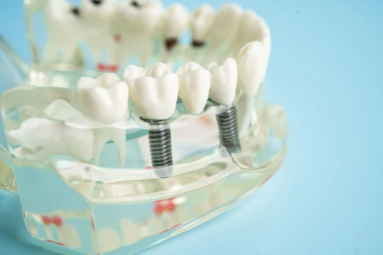 dental implants
