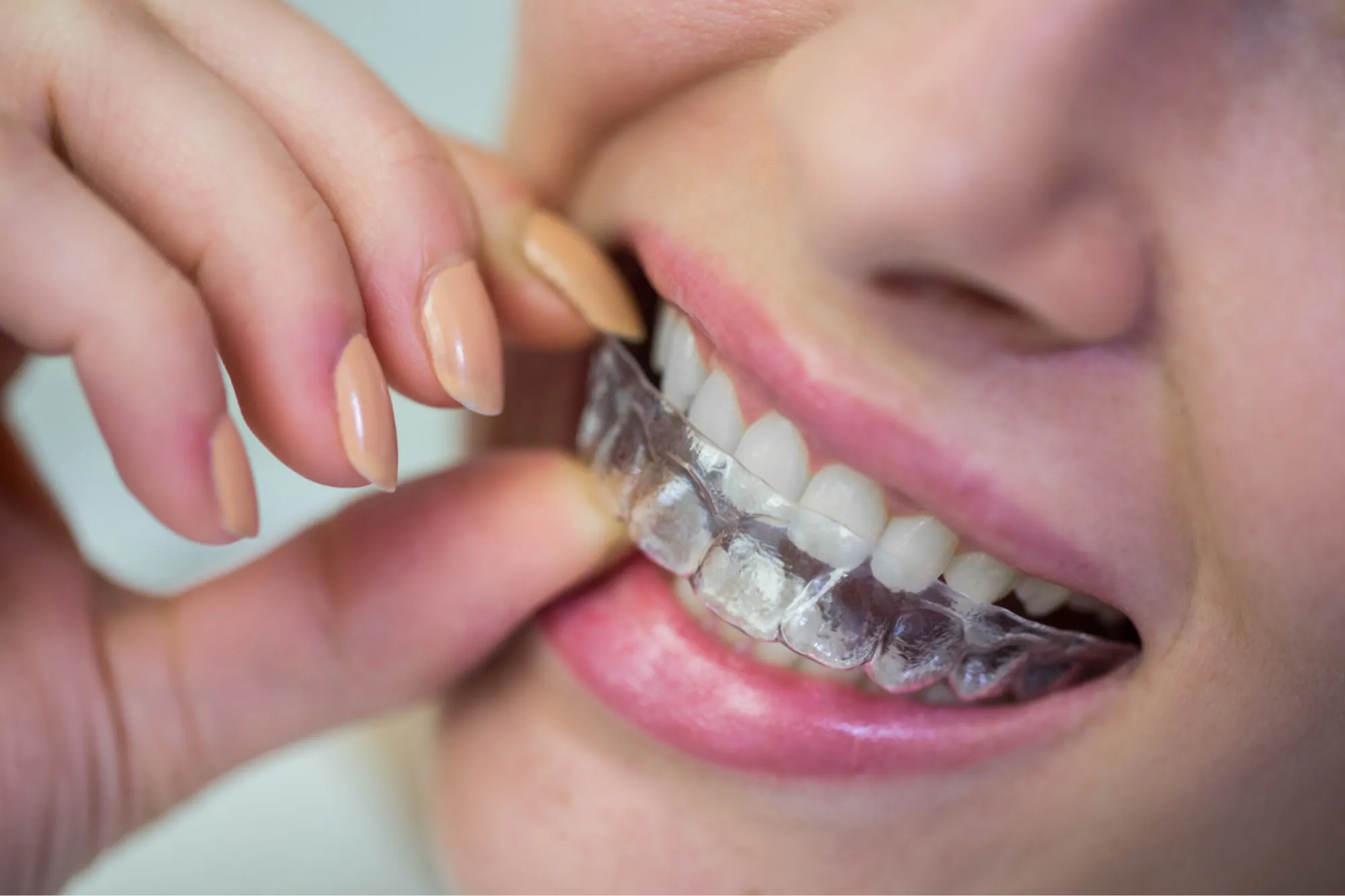 Looking for a Trusted Dentist Near Me? Welcome to Your New Dental Home. - Your Digital Dentist Invisalign in Jacksonville, FL