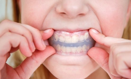 Custom-Sports-Mouth-Guards