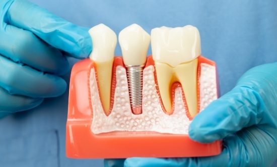 Dental-Implants