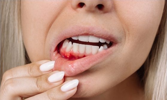 Gum Grafting in Jacksonville