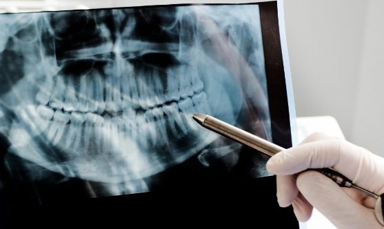 Oral-Cancer-Screenings