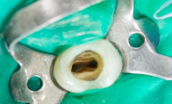 Root-Canal-Treatment