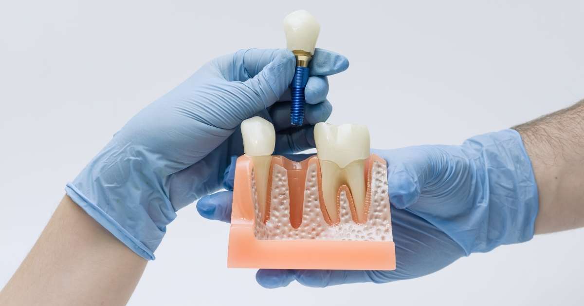dental implant aftercare​