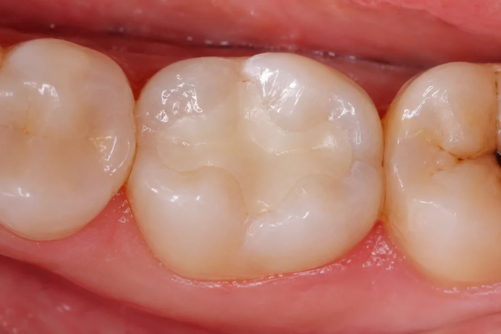 Tooth-Colored Fillings - Dental Fillings