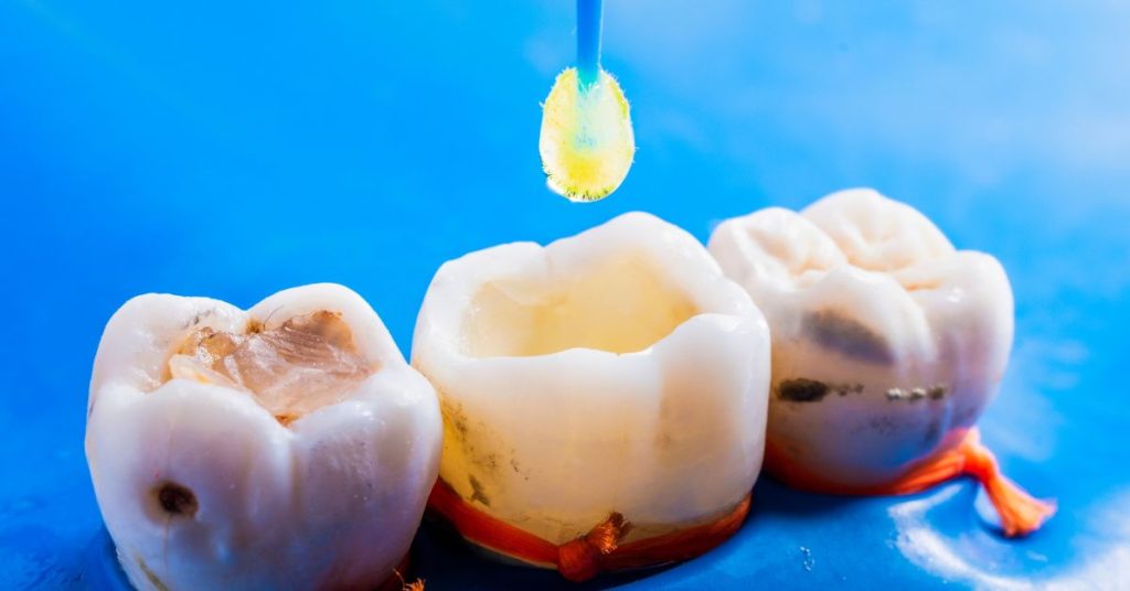 Back Tooth Chipped with Filling: Signs You Need Repair - Your Digital Dentist Back Tooth Chipped with Filling