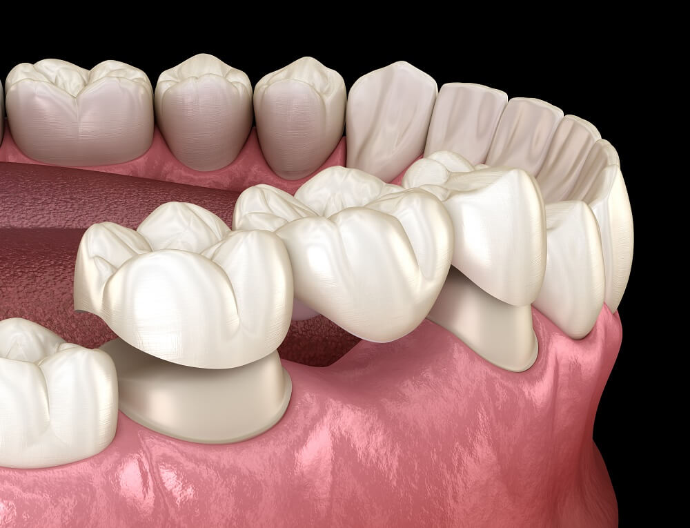 Implant Bridges