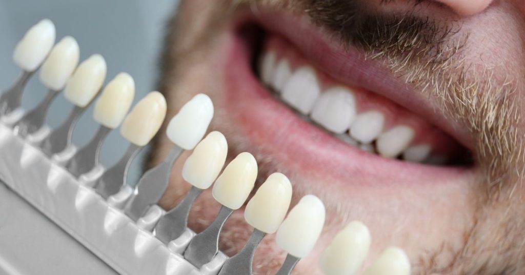 Cost of Porcelain Veneers in Jacksonville: What to Expect - Your Digital Dentist cost of porcelain veneers​ in Jacksonville