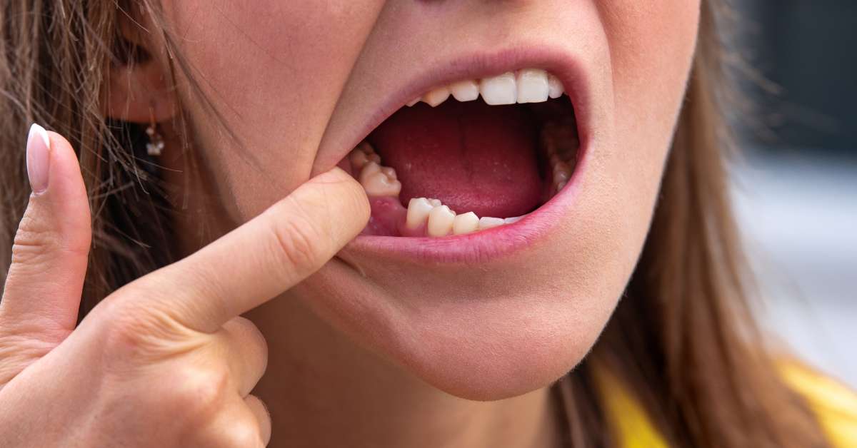 Tooth Extraction Aftercare